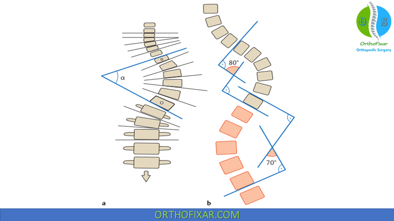 Cobb Angle For Scoliosis OrthoFixar 2024