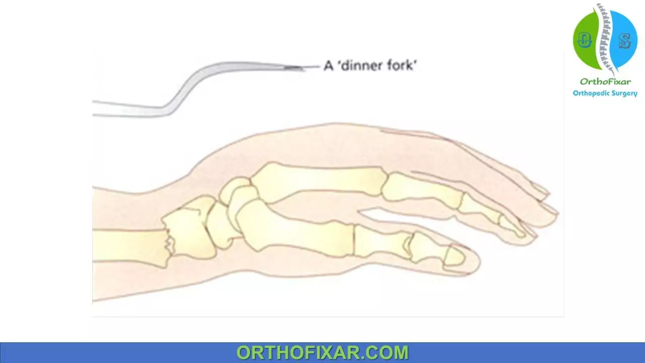 Dinner Fork Deformity