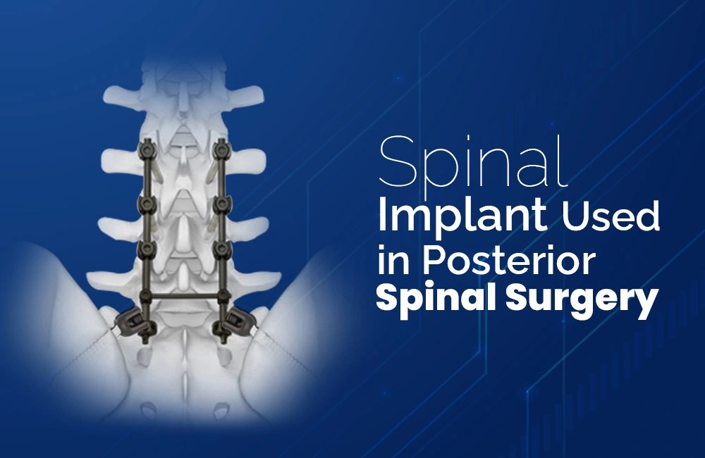 Posterior Spinal Surgery A Guide to its Implants Zealmax Innovations