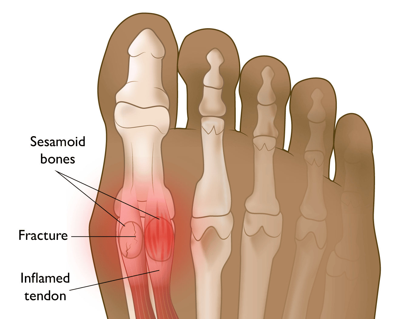 Sesamoiditis and Sesamoid Fracture OrthoInfo AAOS