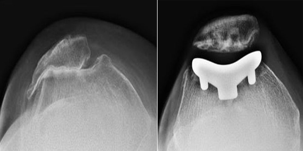 Patellofemoral Arthritis OrthoInfo AAOS