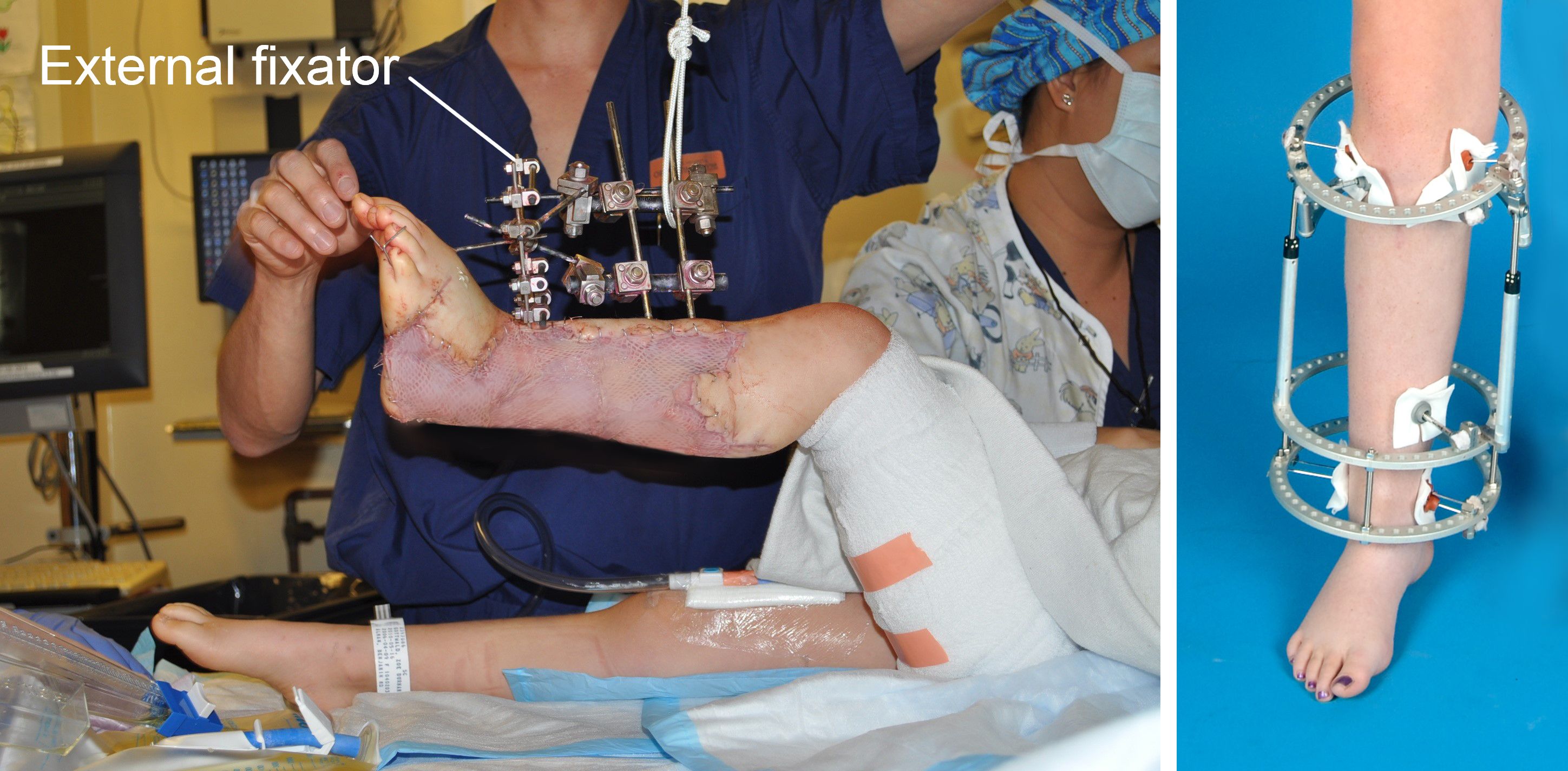 Lawn Mower Injuries in Children OrthoInfo AAOS