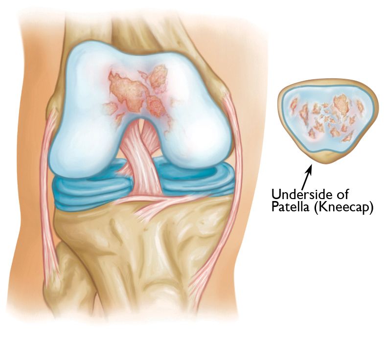 Patellofemoral joint replacement Dr. Brook Adams, MD