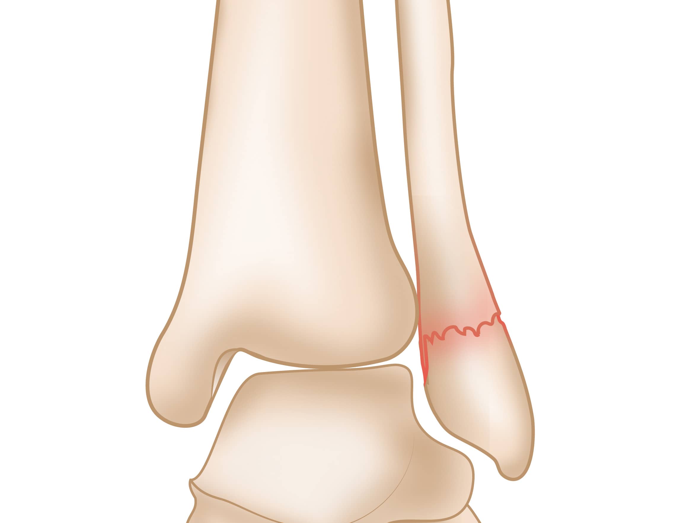 Ankle Fractures (Broken Ankle) OrthoInfo AAOS