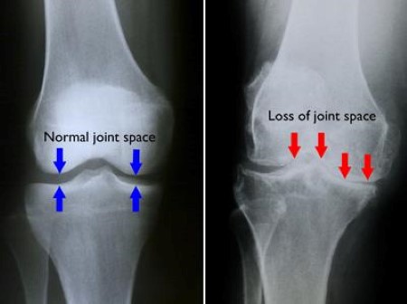 Arthritis Of The Knee - Orthoinfo - Aaos