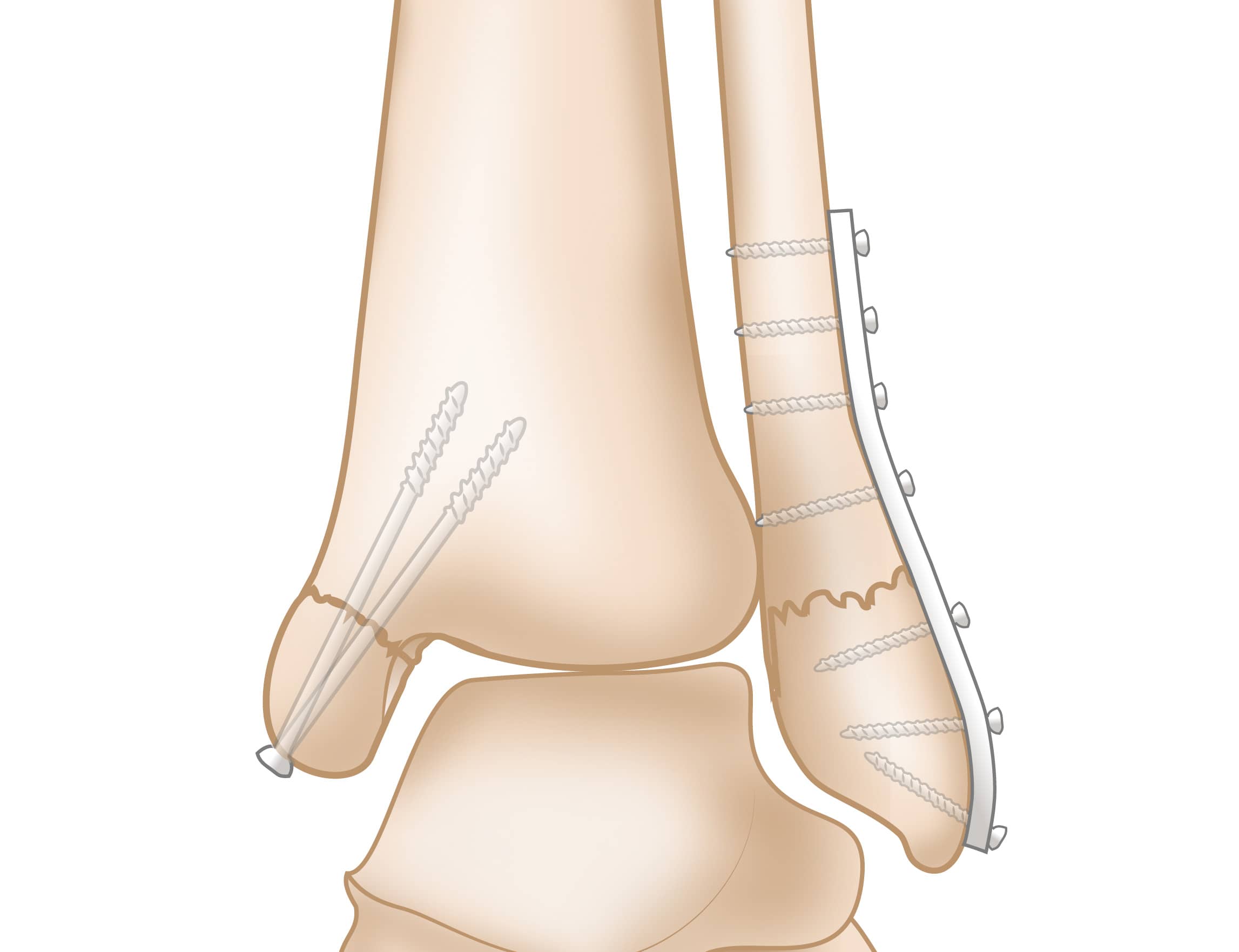 Ankle Fractures (Broken Ankle) OrthoInfo AAOS