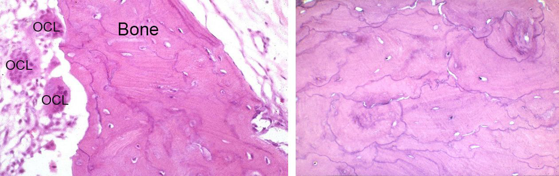 Paget's Disease of Bone Symptoms and Treatment OrthoInfo AAOS