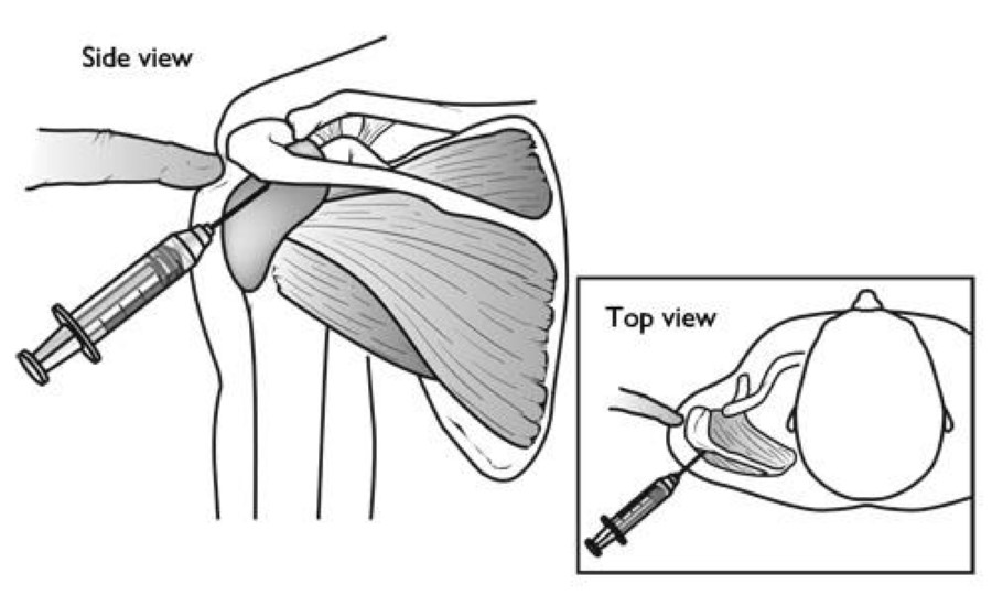 Shoulder Injuries in the Throwing Athlete OrthoInfo AAOS