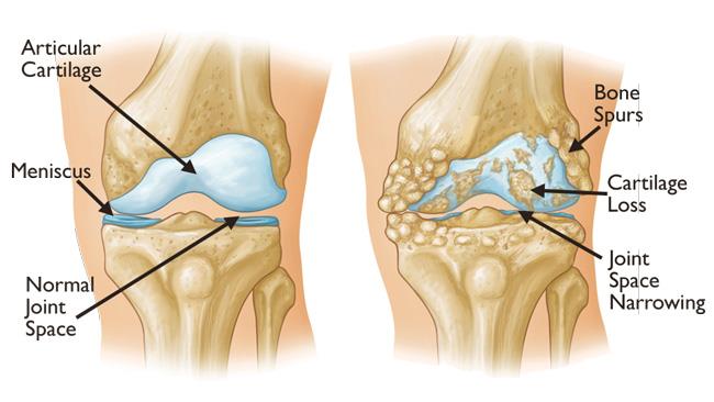 Arthritis Of The Knee - Orthoinfo - Aaos