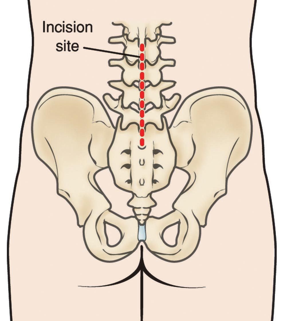 Spinal Fusion Posterolateral Lumbar Fusion OrthoInfo AAOS