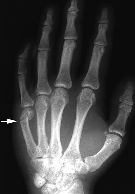 Finger Fractures OrthoInfo AAOS
