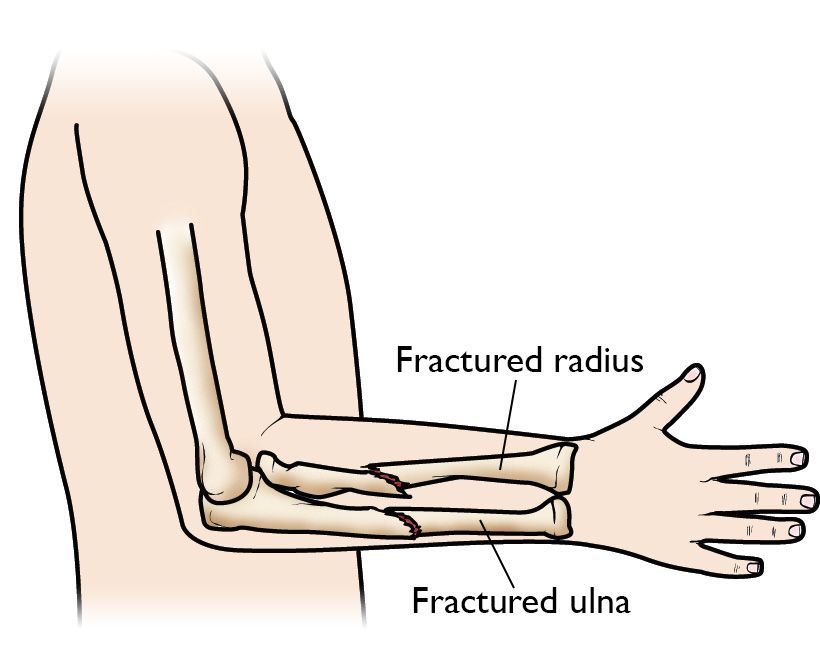 Forearm Fractures in Children Types and Treatments OrthoInfo AAOS