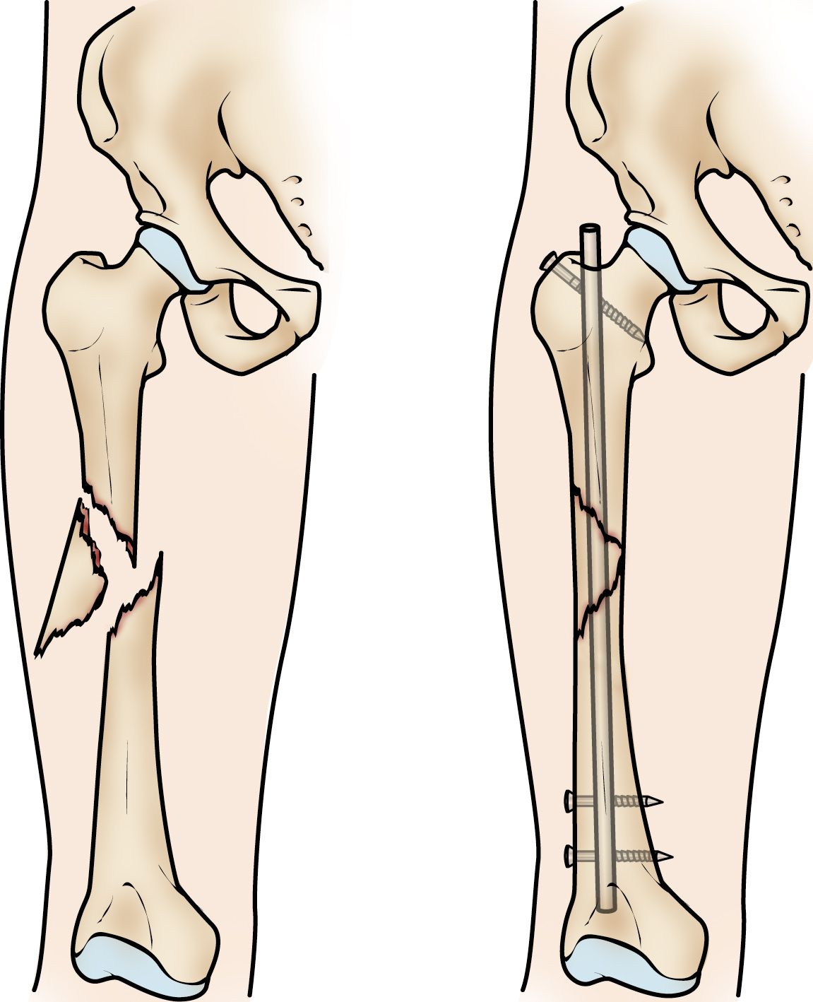 Femur Shaft Fractures (Broken Thighbone) OrthoInfo AAOS