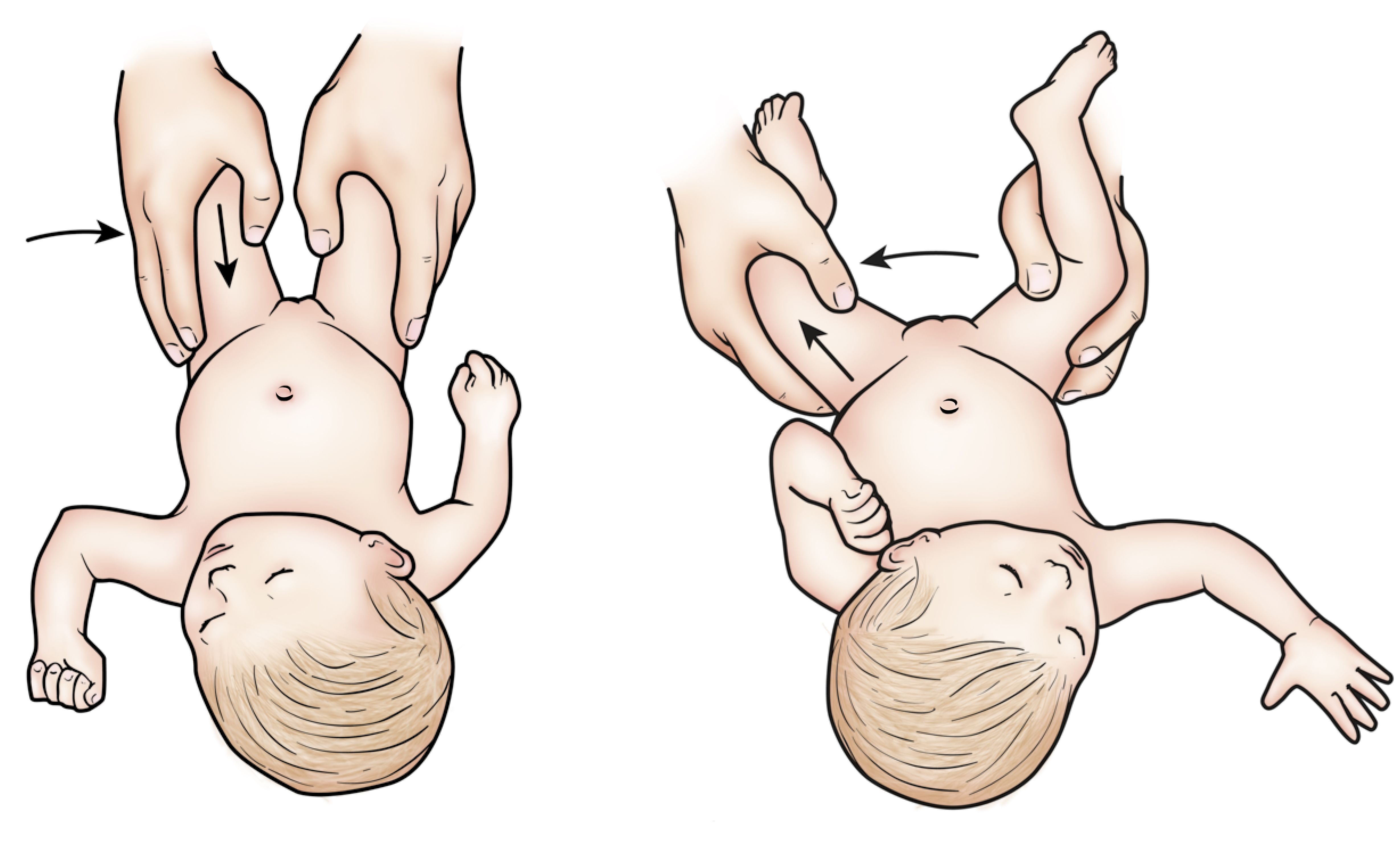 Developmental Dislocation (Dysplasia) of the Hip (DDH) OrthoInfo AAOS