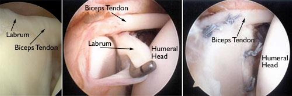 SLAP Tears OrthoInfo AAOS