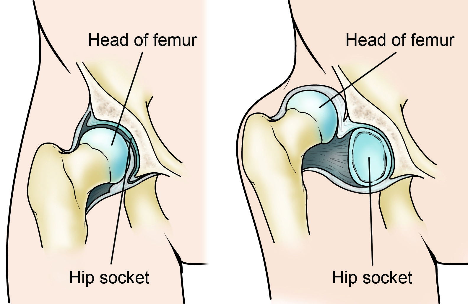Developmental Dislocation (Dysplasia) of the Hip (DDH) OrthoInfo AAOS