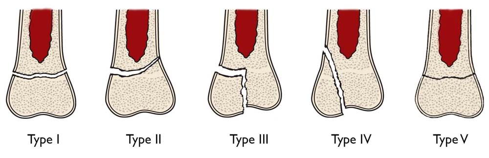 Upper Extremity Limb Length Discrepancy OrthoInfo AAOS