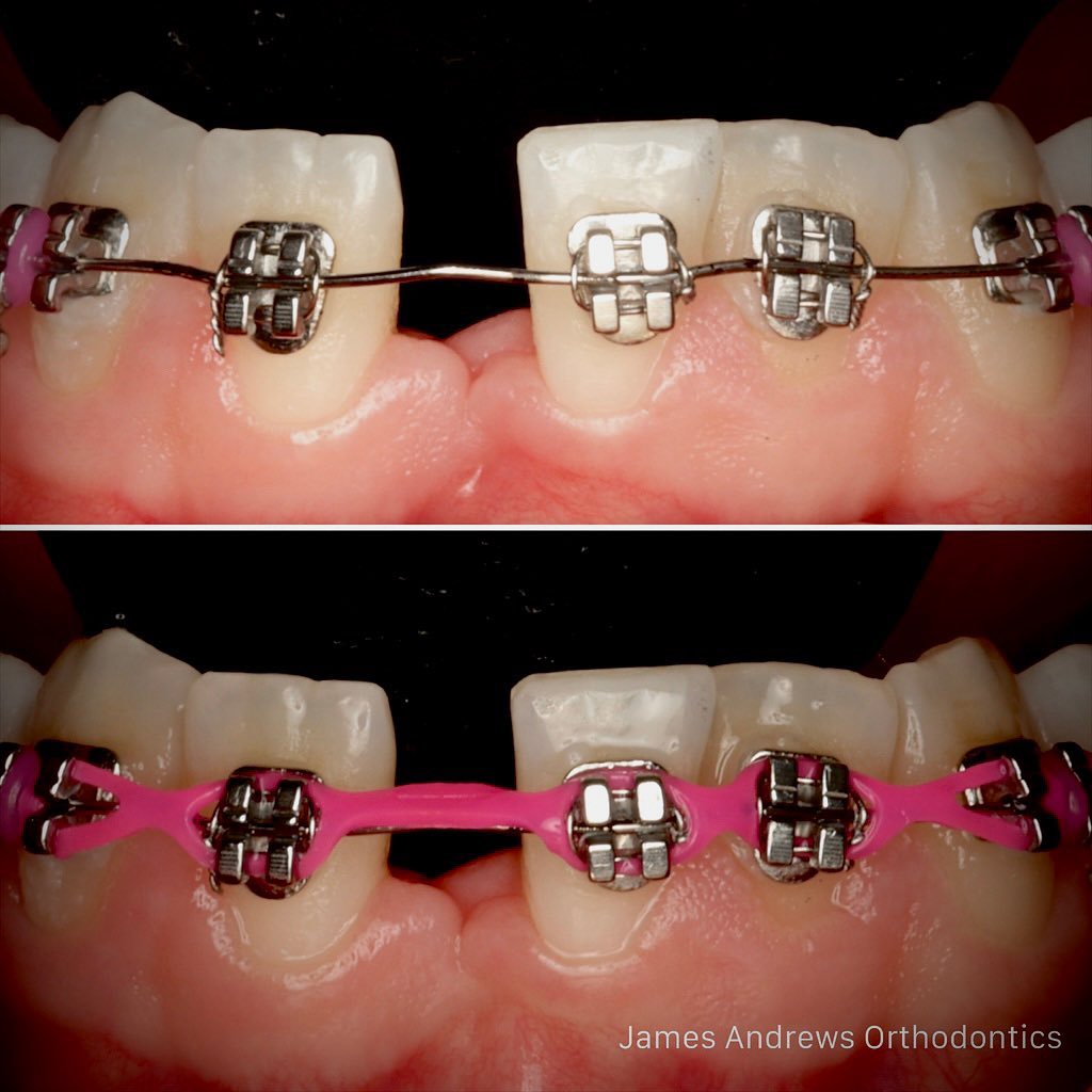 Lower incisor extraction in orthodontics Dastardly or excellence