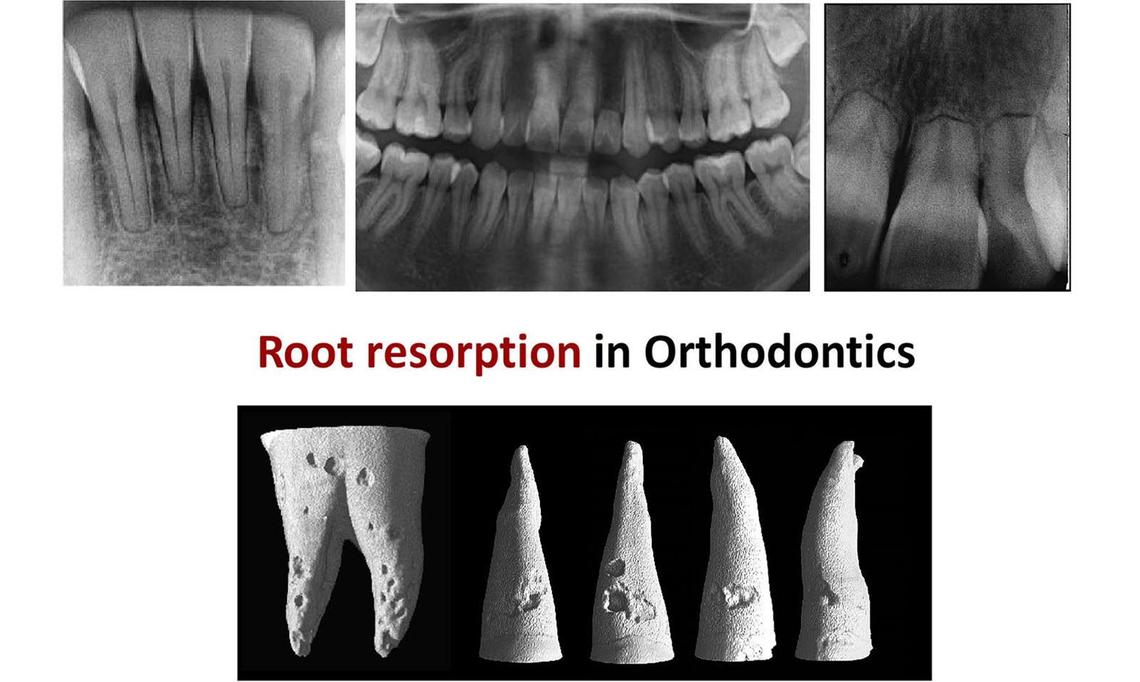 Root Resorption Histology