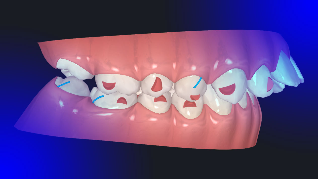 Clear Aligner Treatment of Class II Cases Invisalign Bite Correction