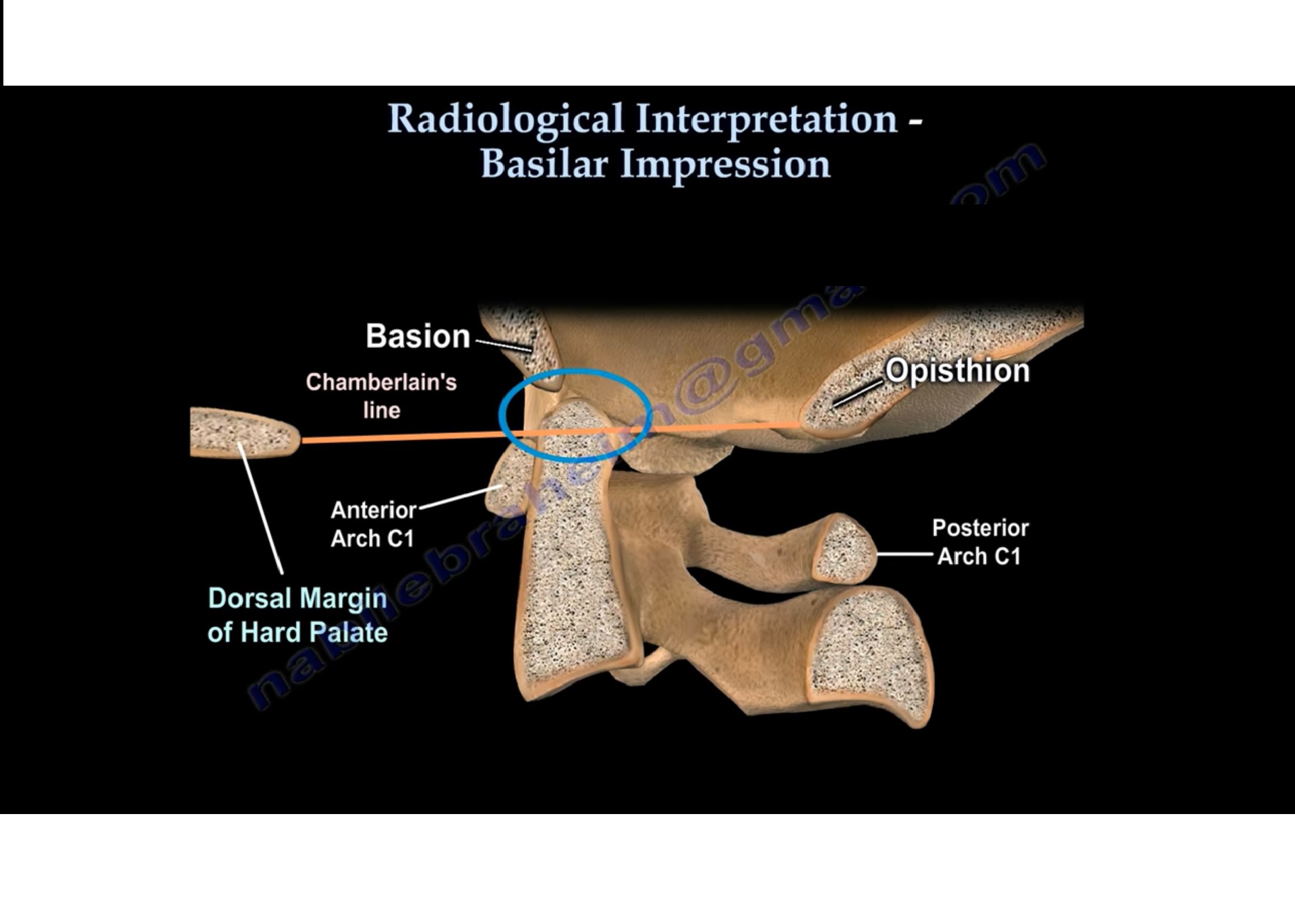 Basilar Impression —