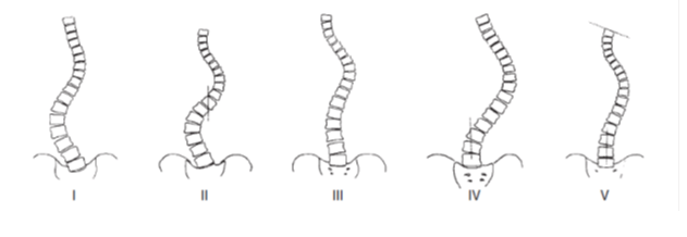 Idiopathic Scoliosis —