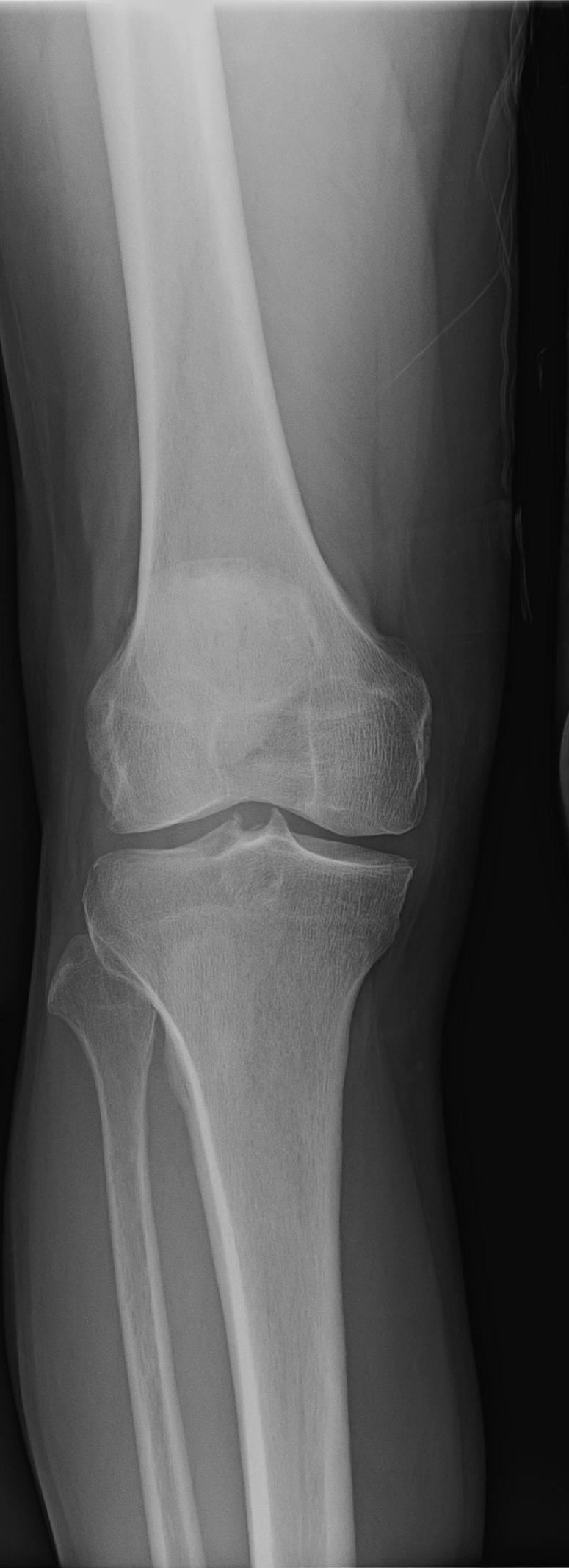 Case Study, Knee Osteoarthritis, AAOS Evidence Based Practice