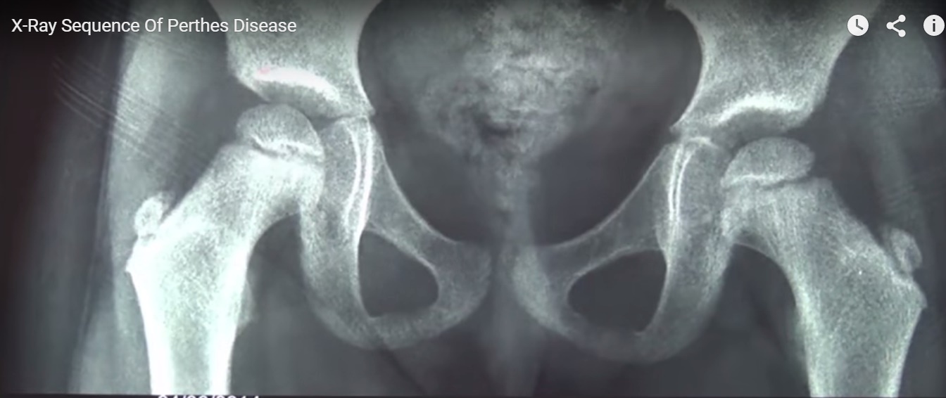 Perthe’s Disease Radiology —