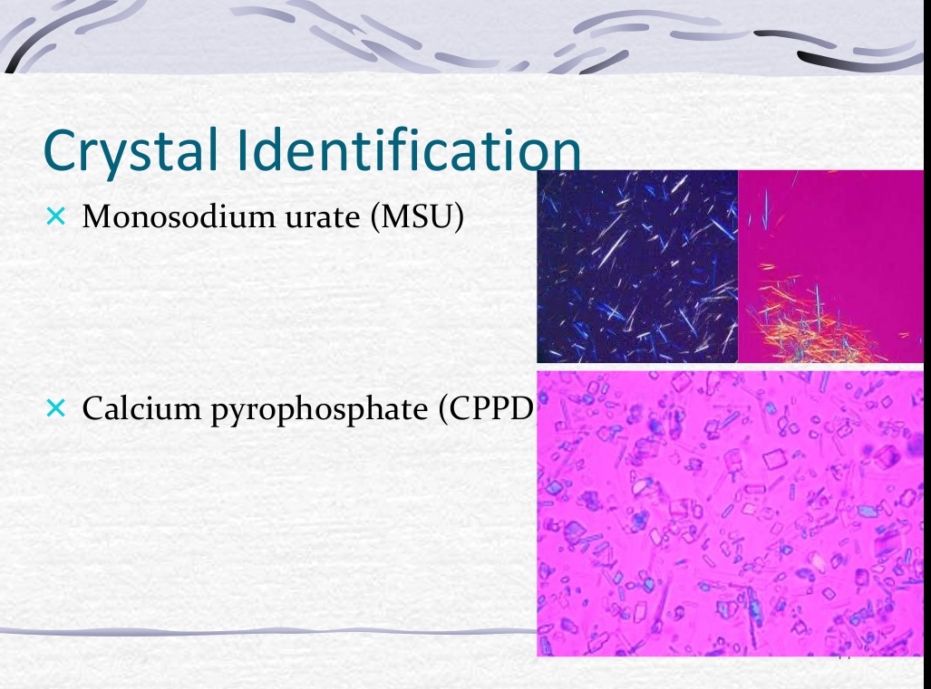 Clinical applications of Synovial (joint ) fluid Analysis