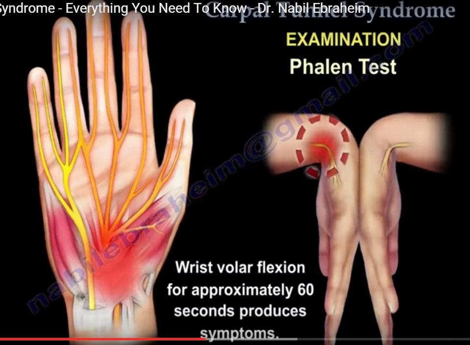 Carpal Tunnel Syndrome —