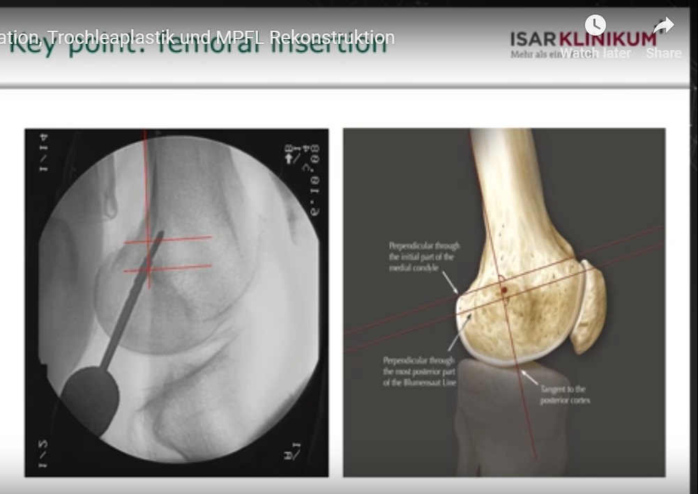 MPFL Reconstruction and Trochleoplasty
