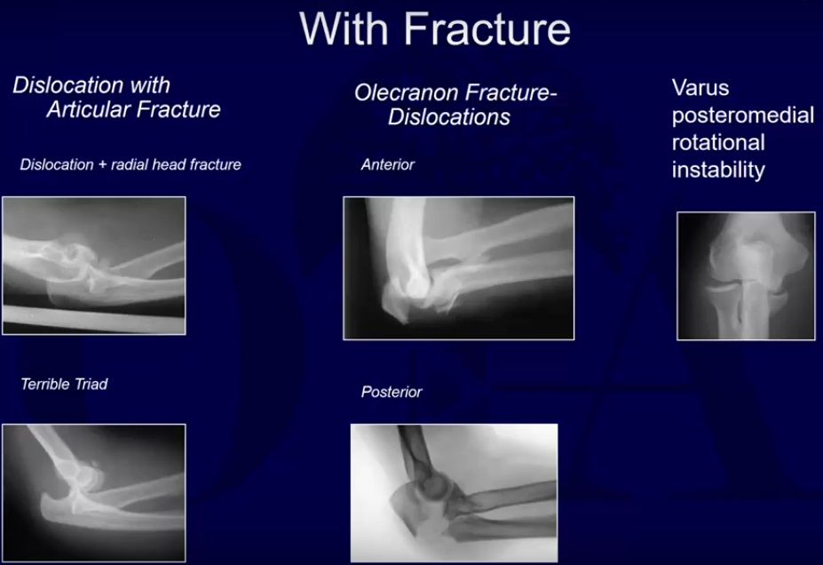Traumatic Elbow Instability Assessment —
