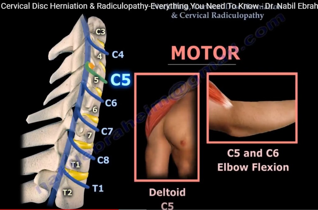 Neck pain, Cervical Disc Herniation and Radiculopathy
