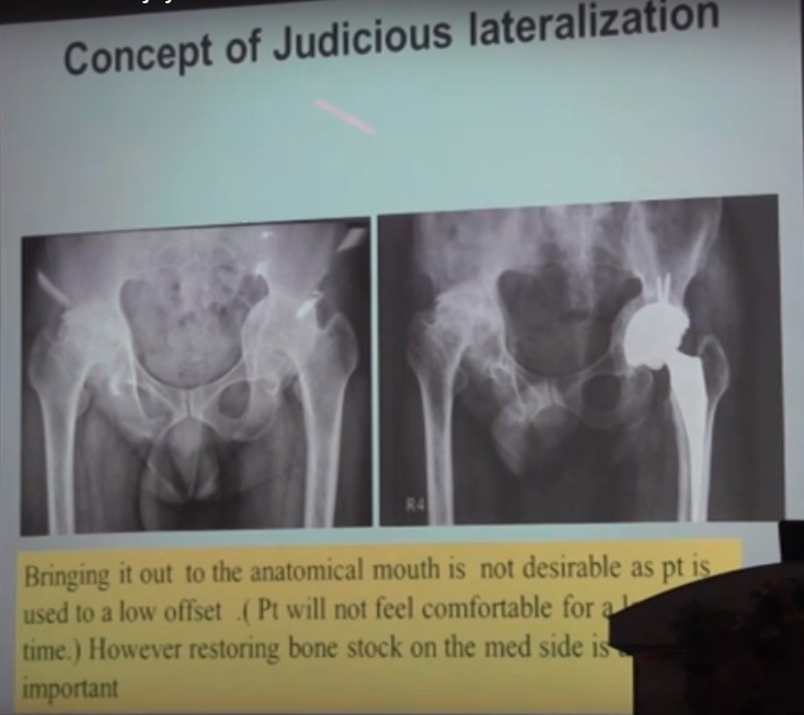 Management of Protrusio in Total Hip Replacement