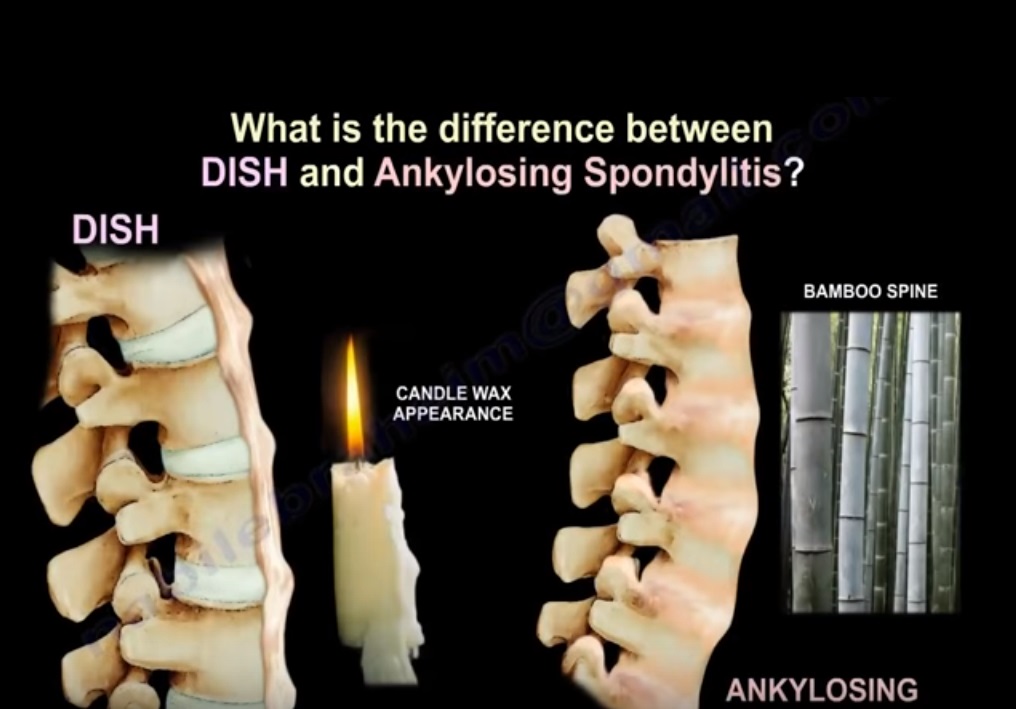 Diffuse Idiopathic Skeletal Hyperostosis —