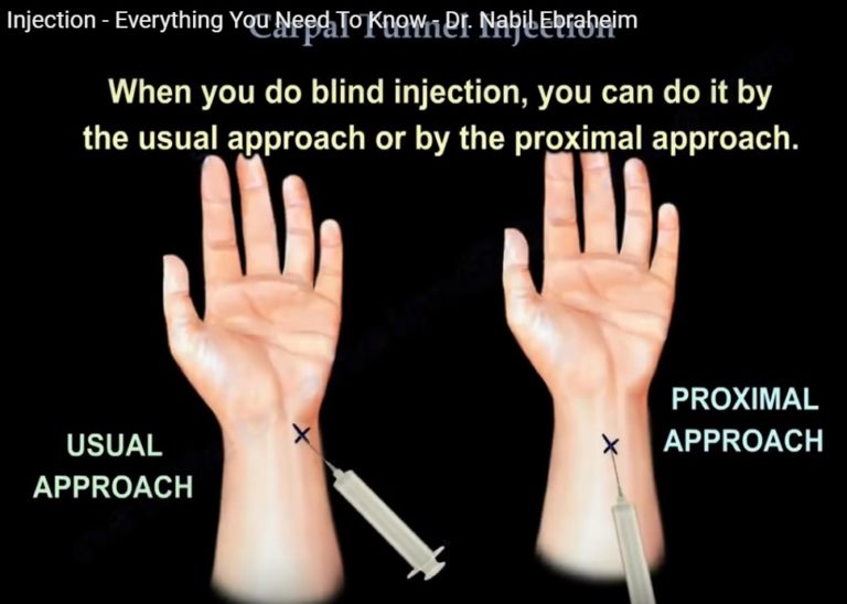 Carpal Tunnel Injection —