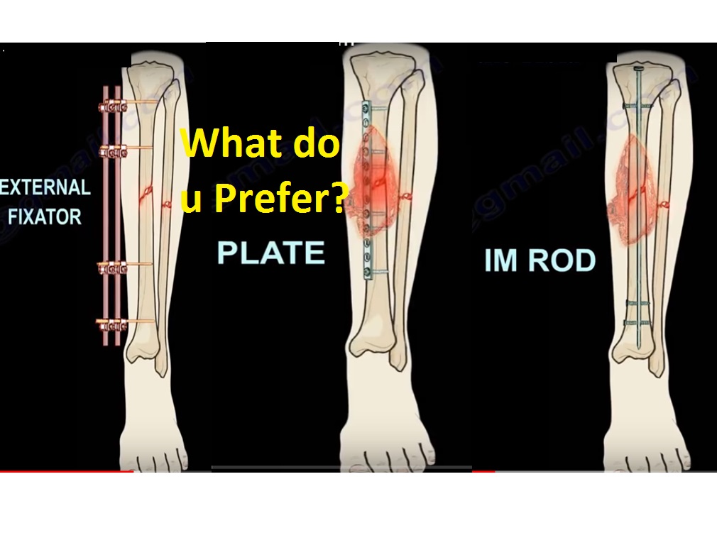 Open Fractures of the Tibia —