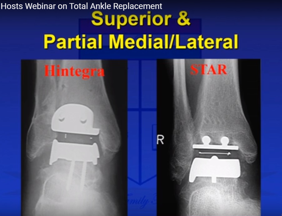 Total Ankle Replacement —