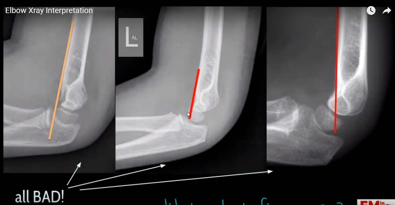 Interpretation of Elbow Xrays —