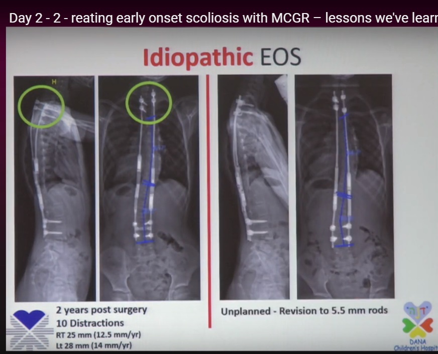 Growth Rods for Early Onset Scoliosis —