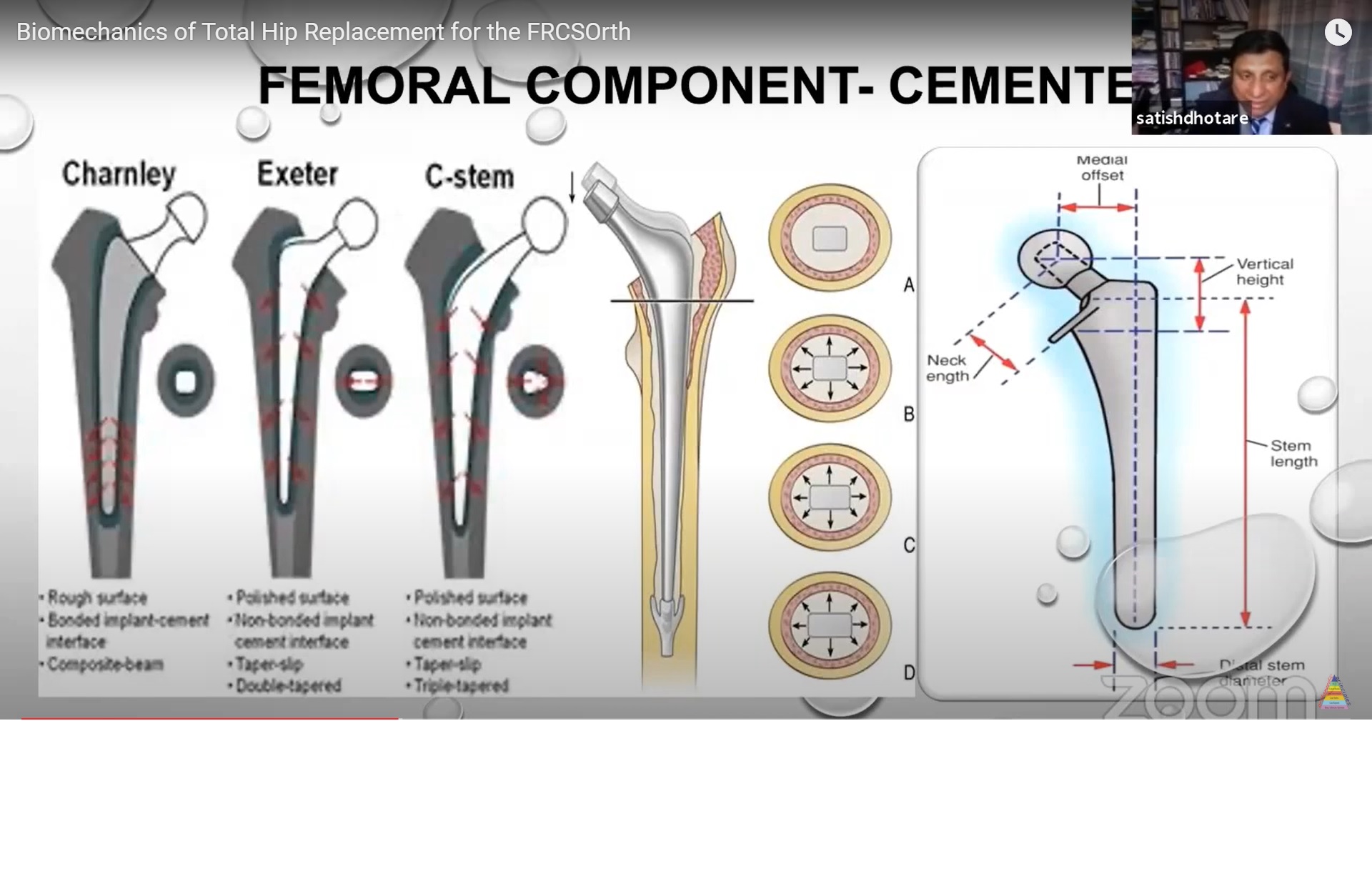 Biomechanics of Total Hip Replacement for the FRCSOrth