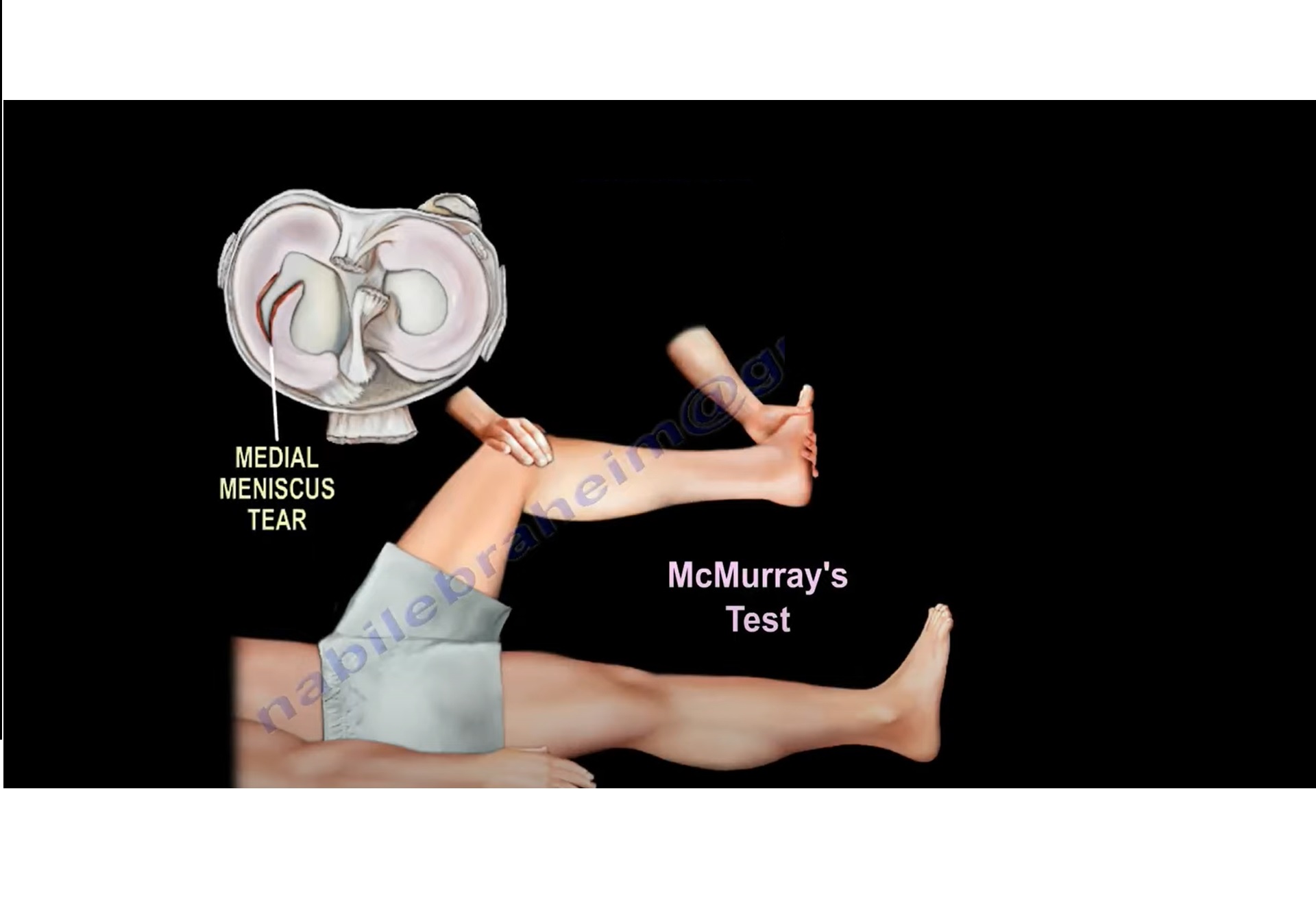 McMurray’s Test for Meniscal Tear —