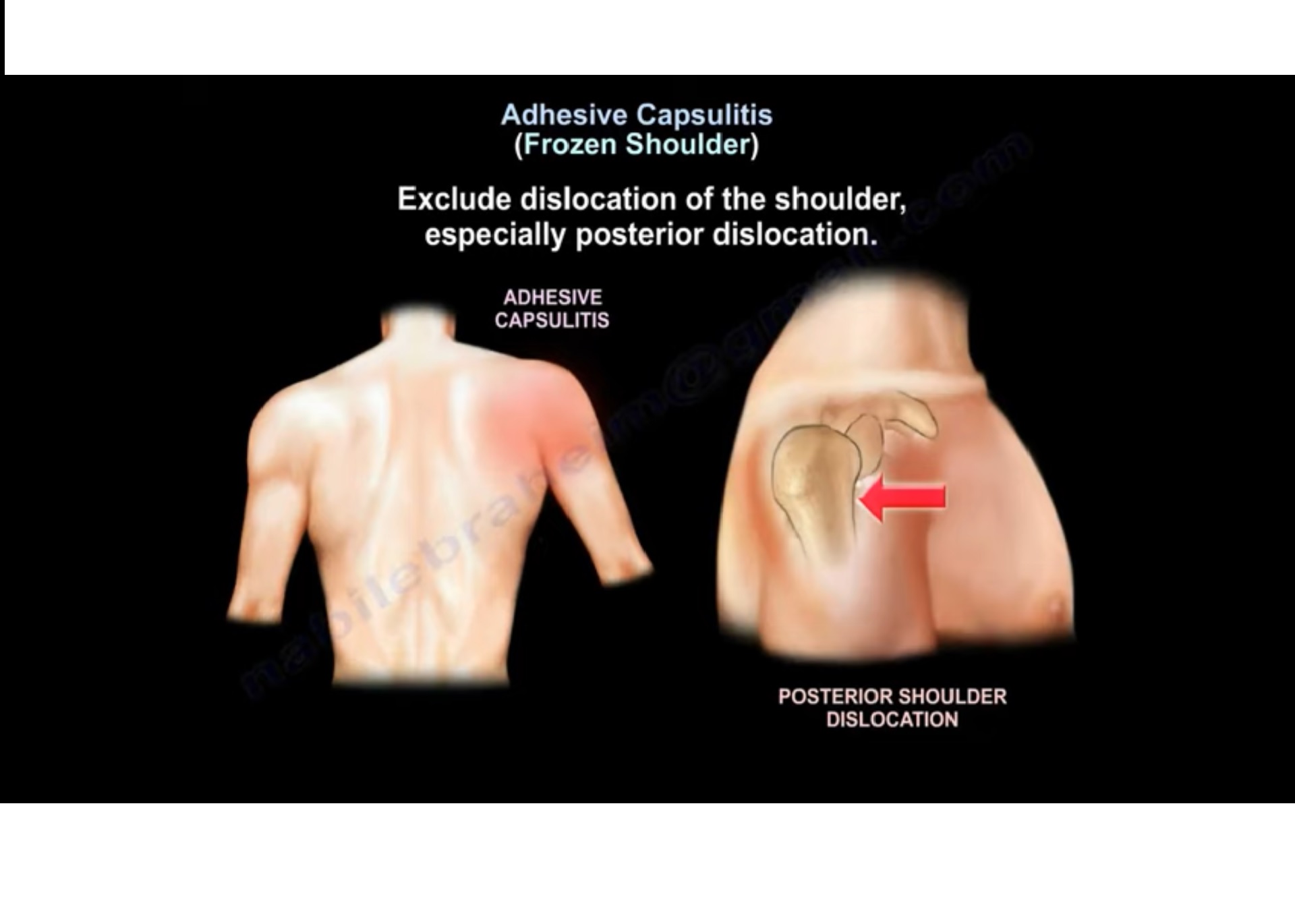 Frozen Shoulder —