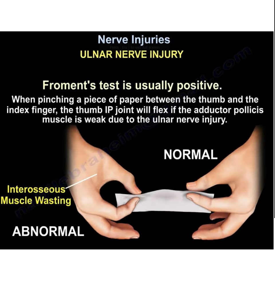 Overview of Nerve Injuries —