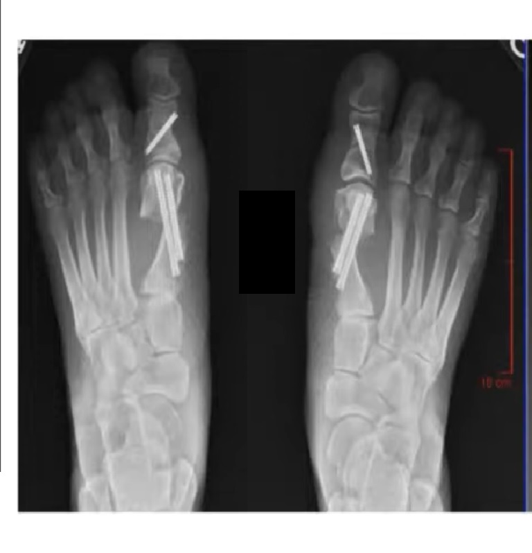 MIS Bunion Correction —
