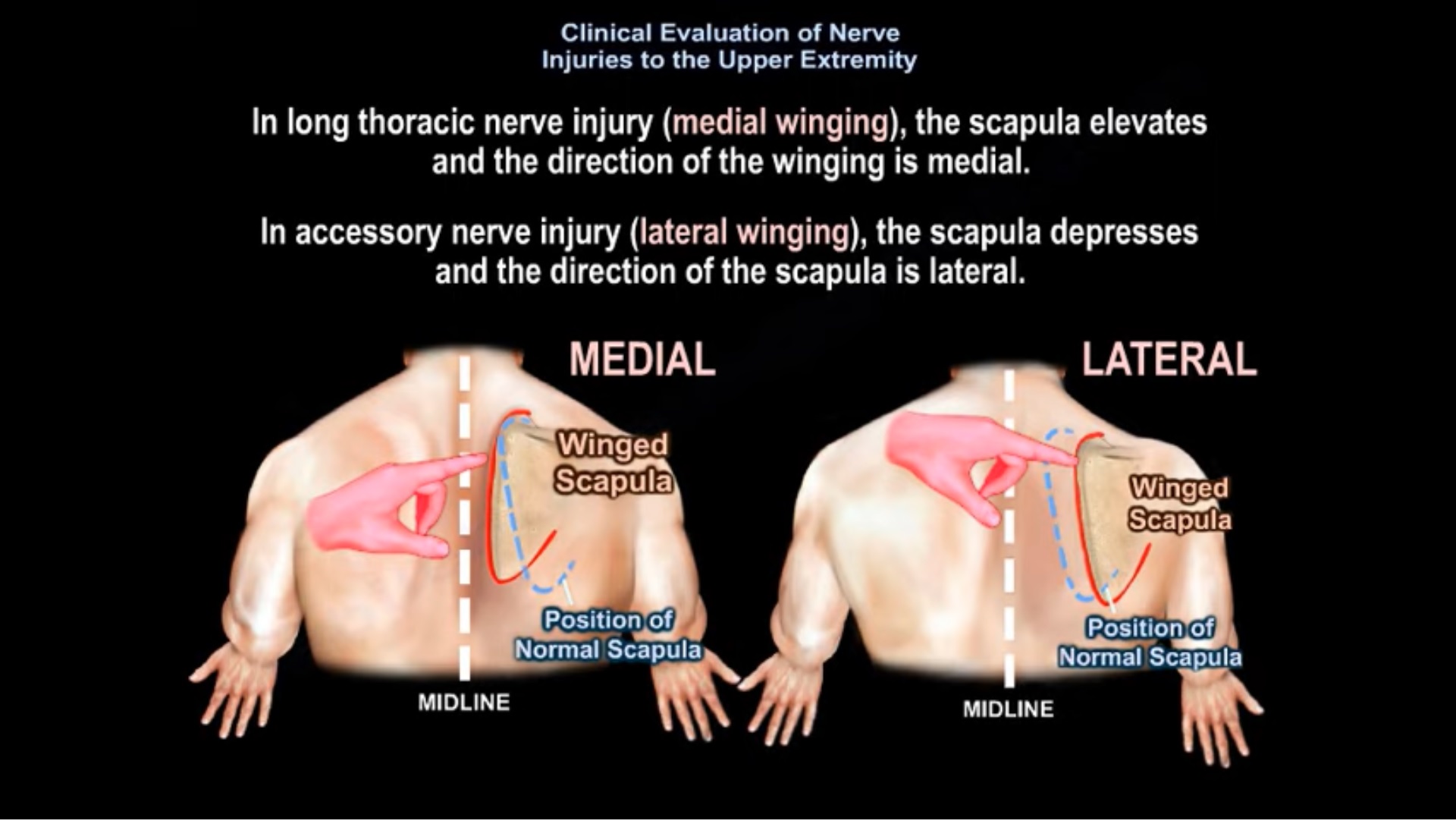 Clinical Exam of Upper limb Nerve Injuries —