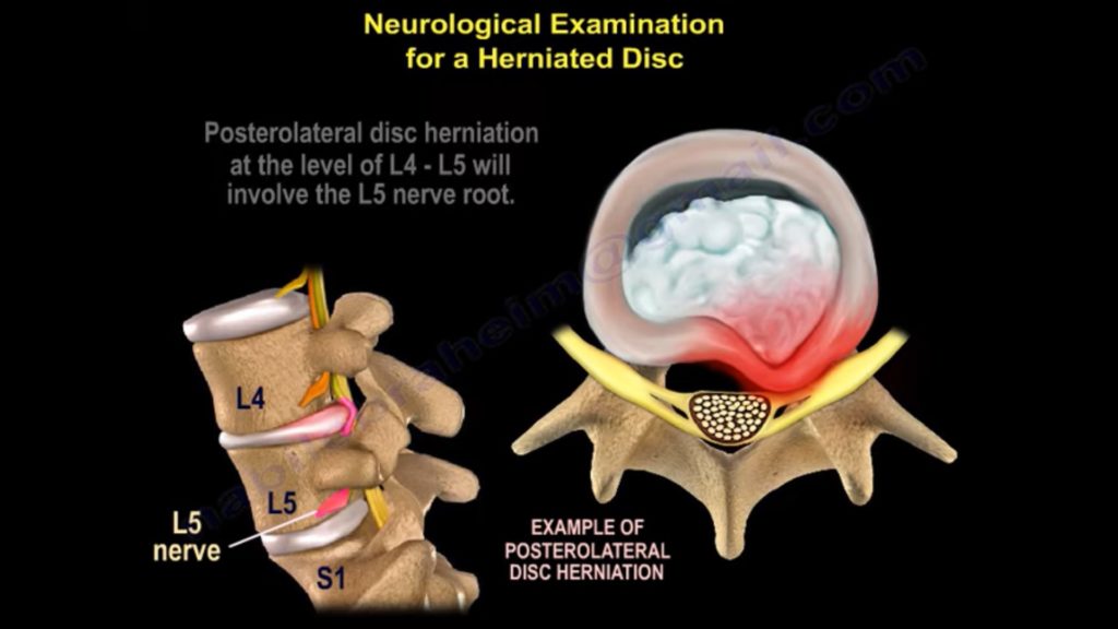 Neurological Examination For A Herniated Disc —