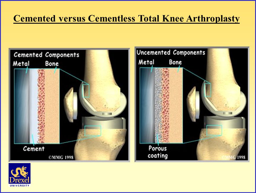 What is a total knee prosthesis Orthoped