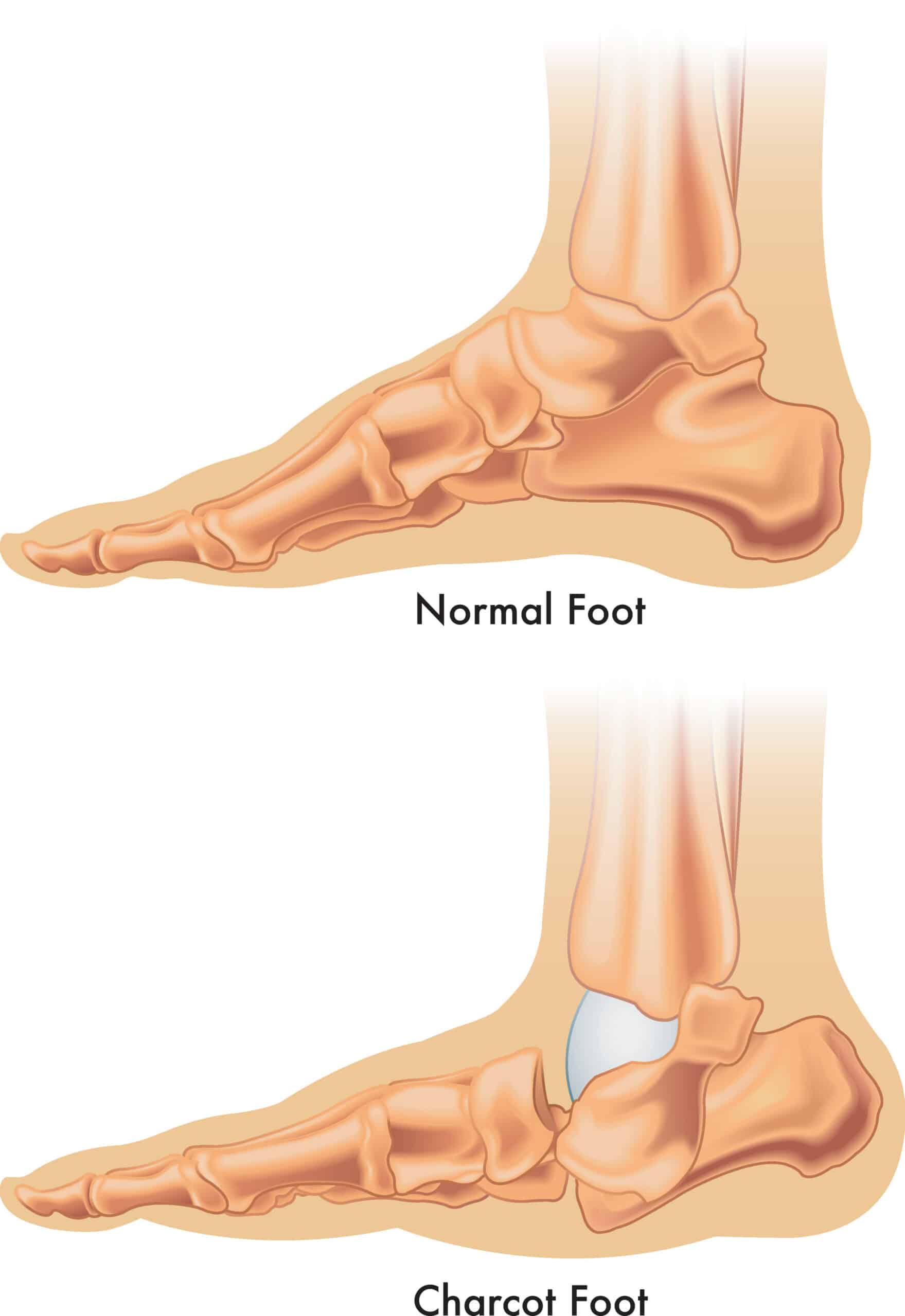 Charcot (RockerBottom) Foot Orthopedic Solutions OKC