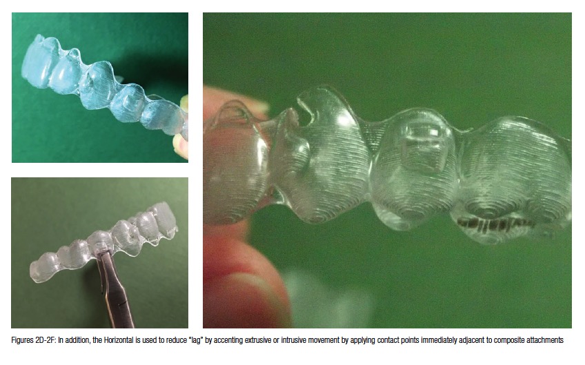 Clear Collection instruments for clear aligner treatments